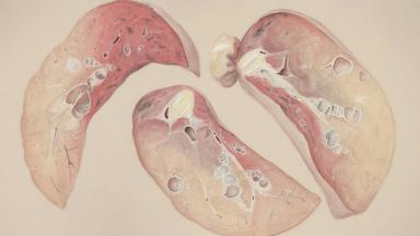 CHC - Transplantation hépatique pour carcinome hépatocellulaire