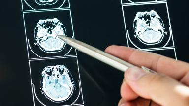 Scanner TEP/TDM au Dotatate - imagerie des tumeurs neuroendocrines