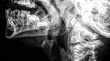 Scan thyroïdien - Scintigraphie thyroïdienne