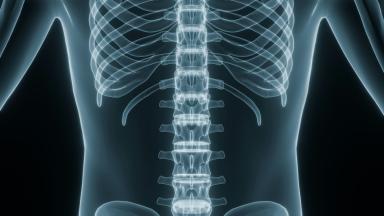 Chirurgie de la scoliose chez l’enfant
