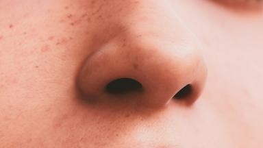 Chirurgie des polypes nasaux